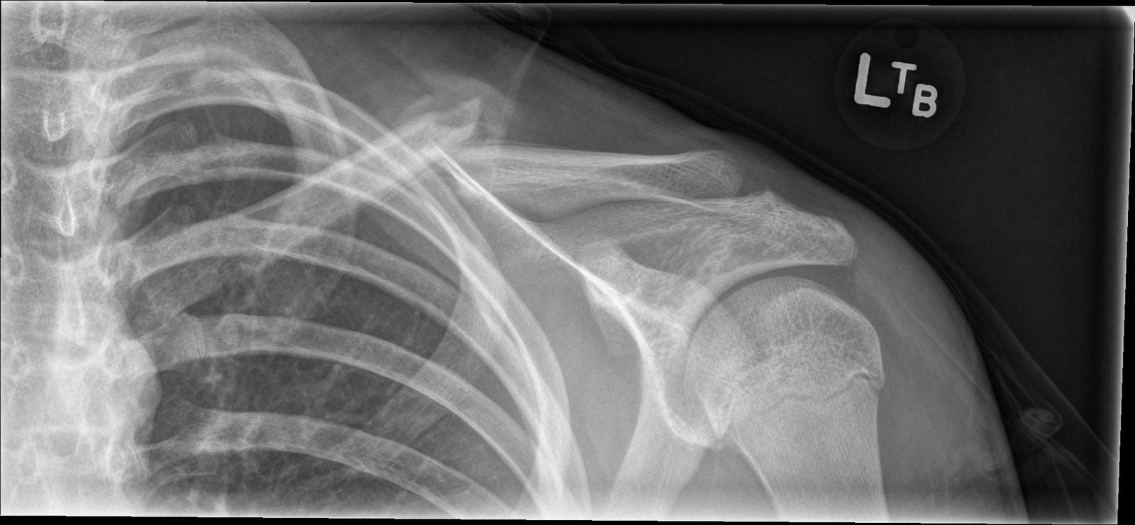 Rebroken collarbone