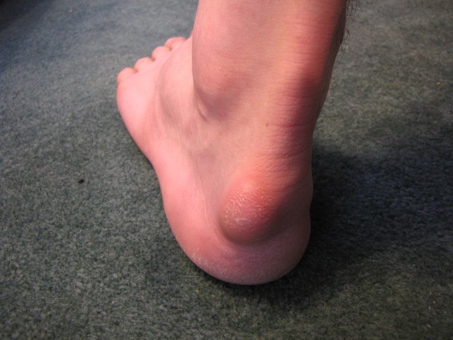 Foot 2