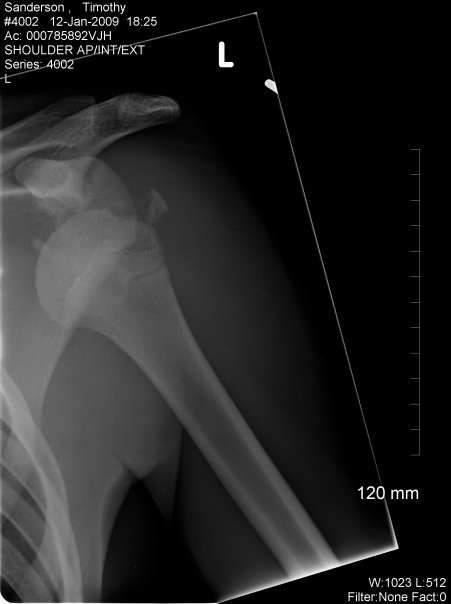 Shoulder x ray