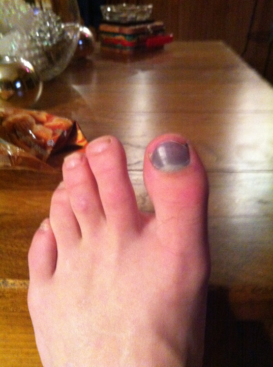 My messed up toe.