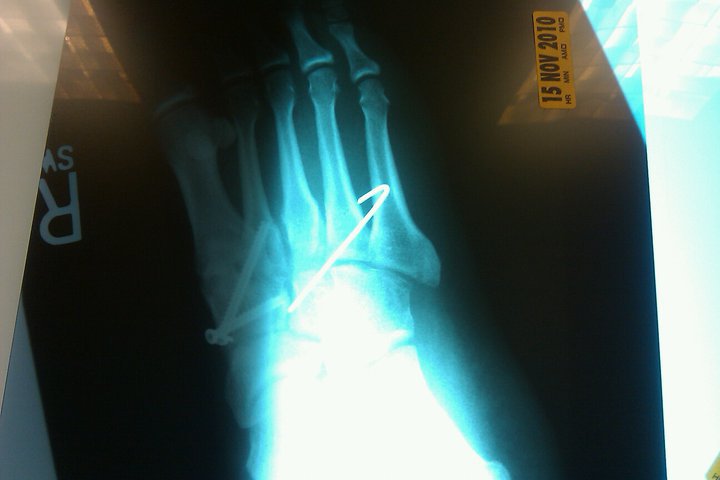 Foot xray