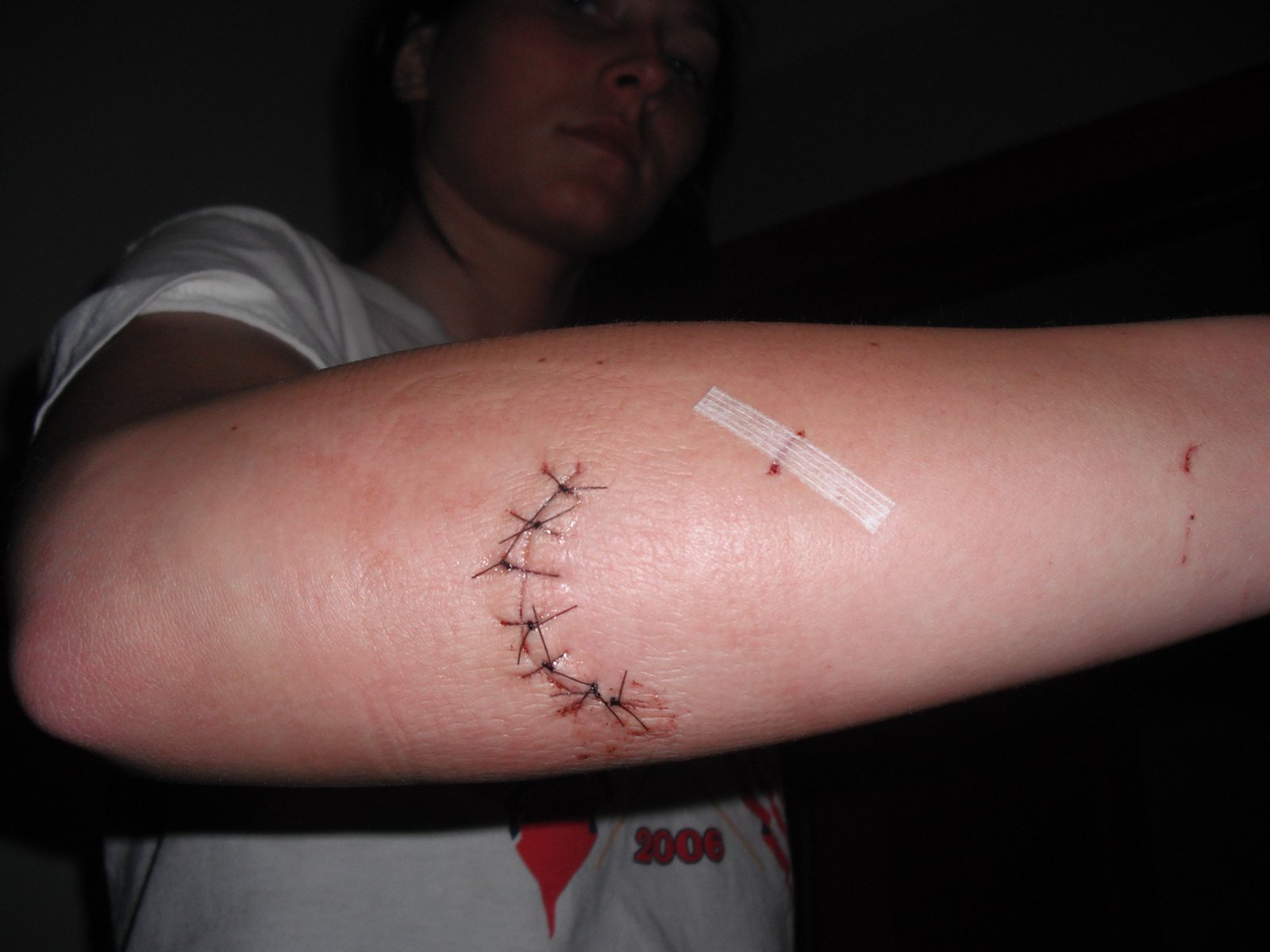 7 stitches