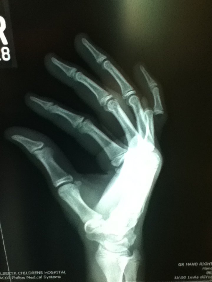 Dislocated pinky