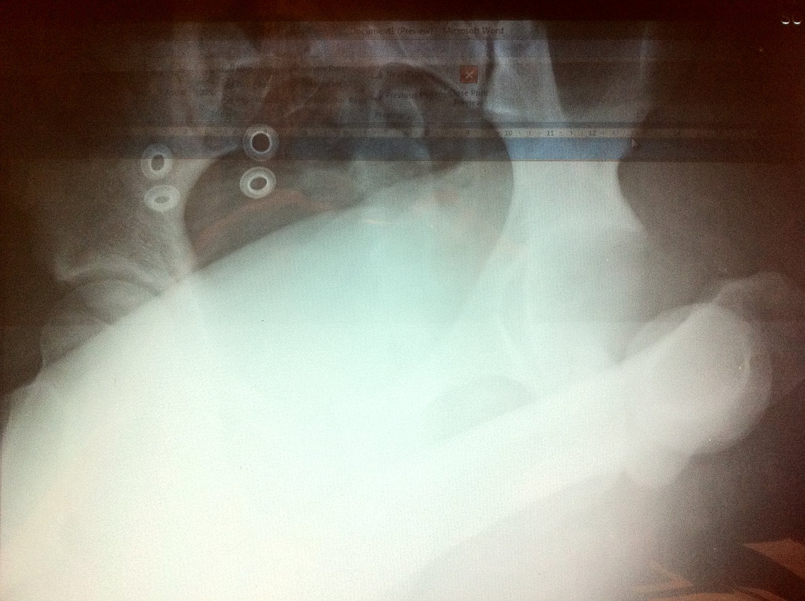 Dislocated hip