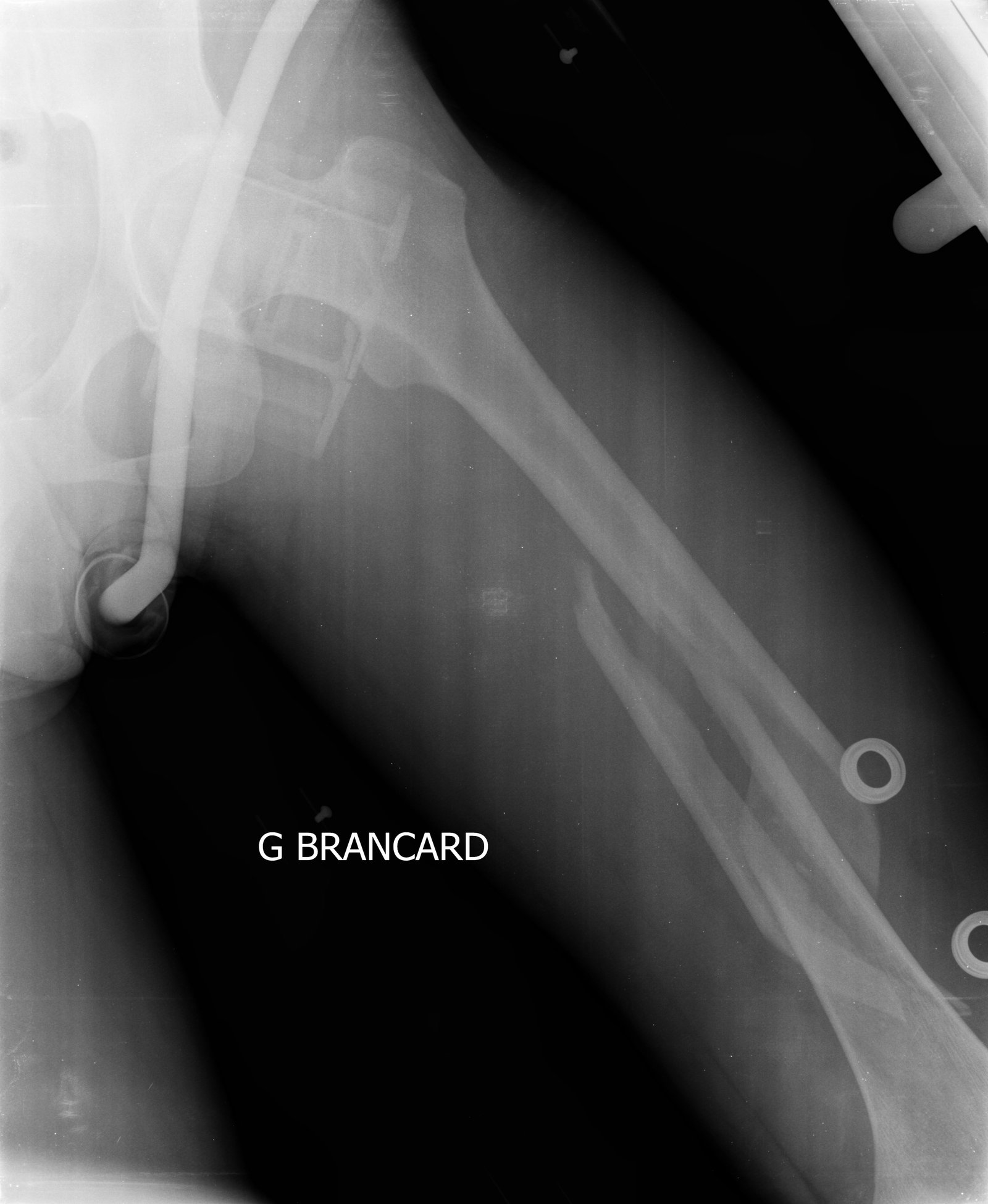 Broken left femur