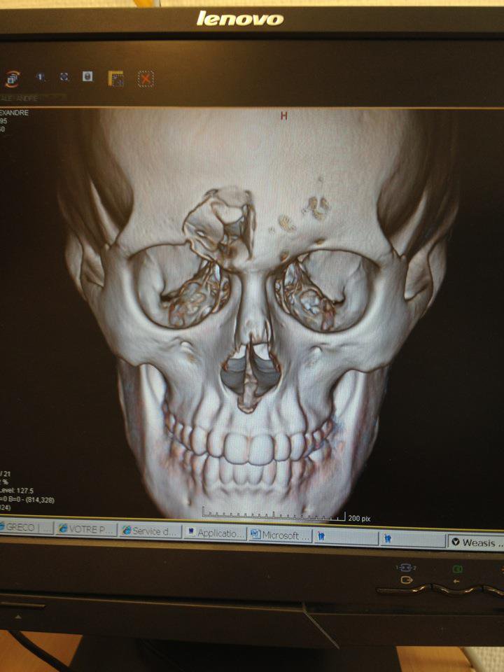 Skull Fracture