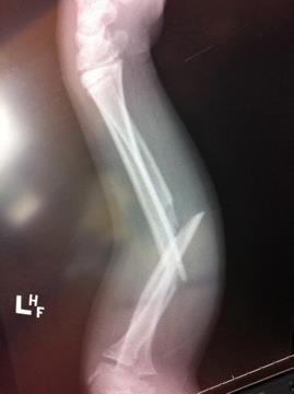 Compound fractured forearm