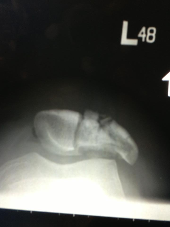 Shattered Knee Cap