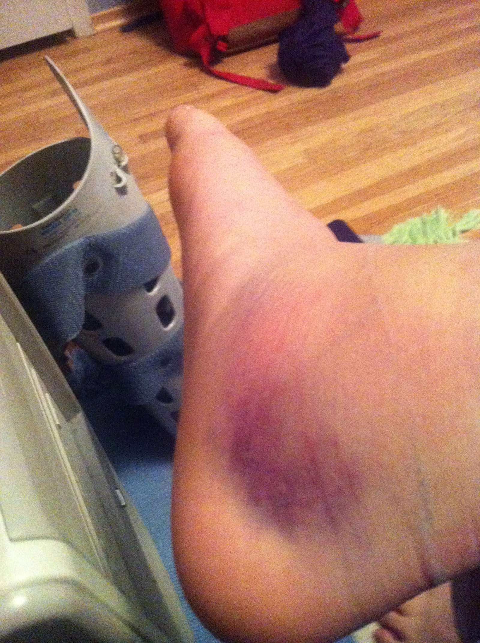 My swollen and bruised foot plus my air cast 
