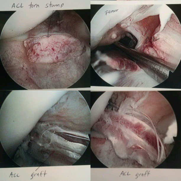 acl surgery yay!