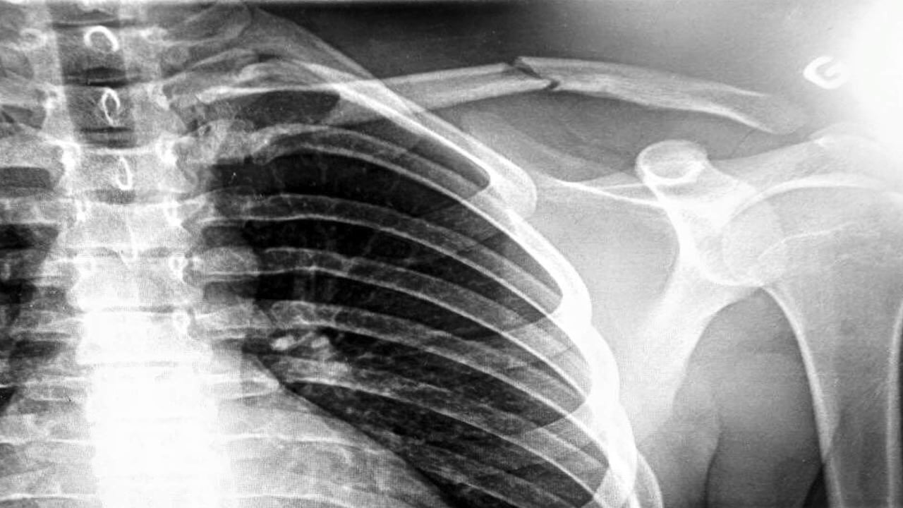 How To Break Your Collarbone - Videos - Newschoolers.com