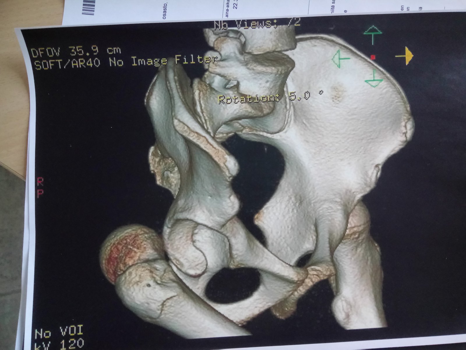 Posterior hip dislocation 