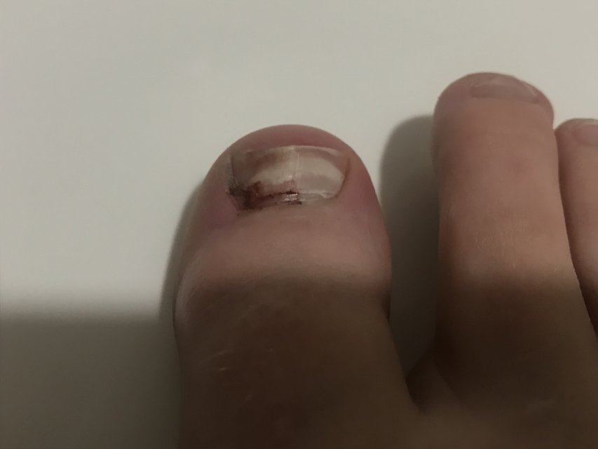 My toenail cracked AMA - Non-Ski Gabber 