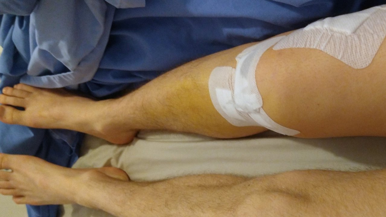 The ACL Diaries: A skier's journey from ACL Tear to recovery - Pt.2 - Surgery and Post-Op